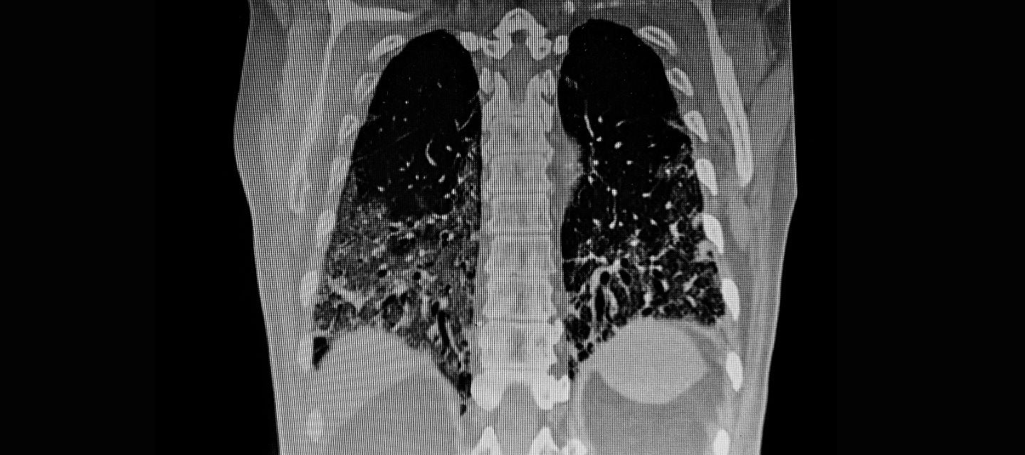 Image of lungs with pneumonia under CT scan 