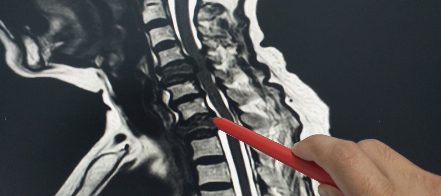 MRI cervical spine image