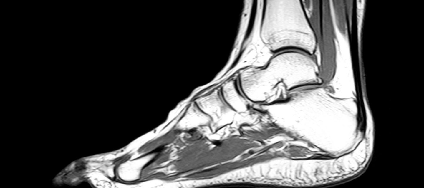 MRI of the foot and ankle