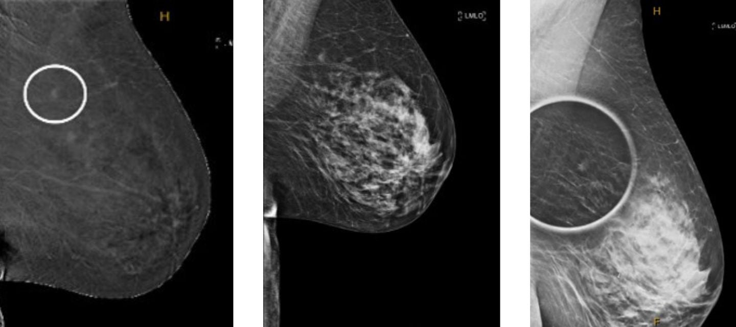 mammography images, contrast enhanced mammography images