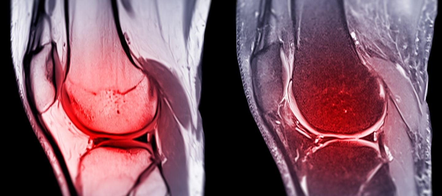 knee mri