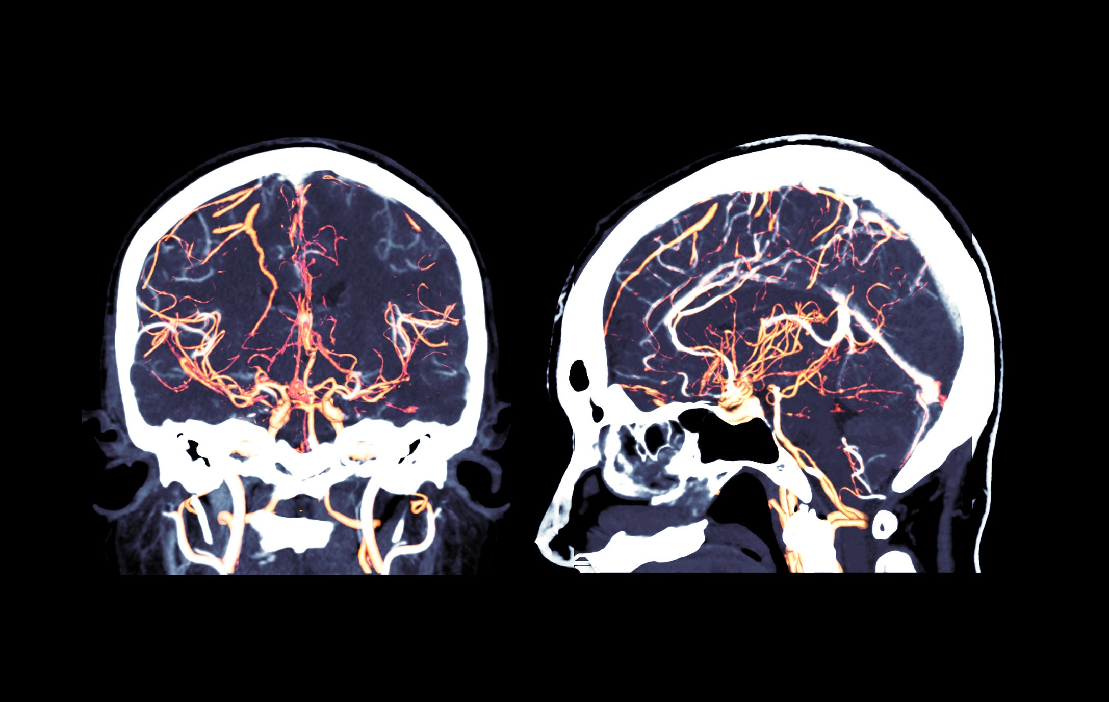 Front and side brain MRI images