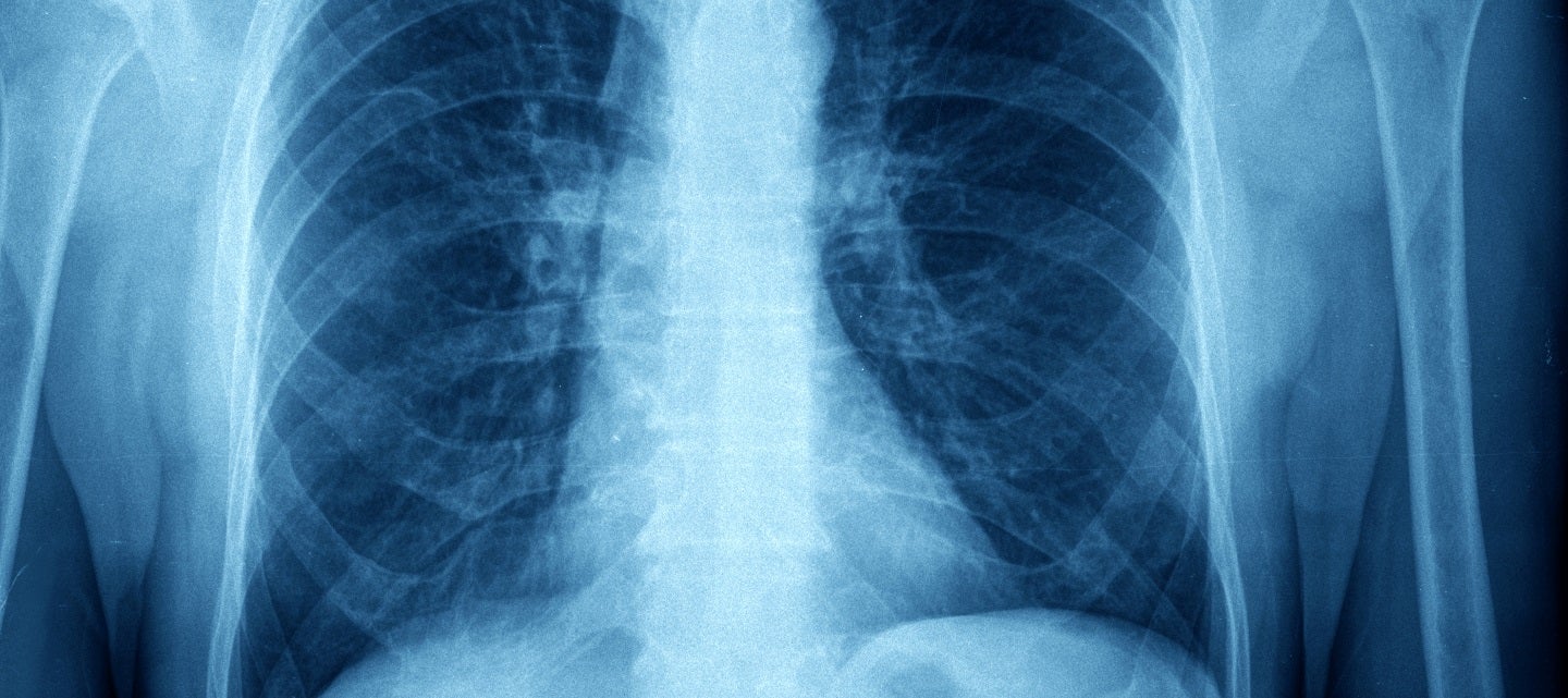 Chest x-ray image