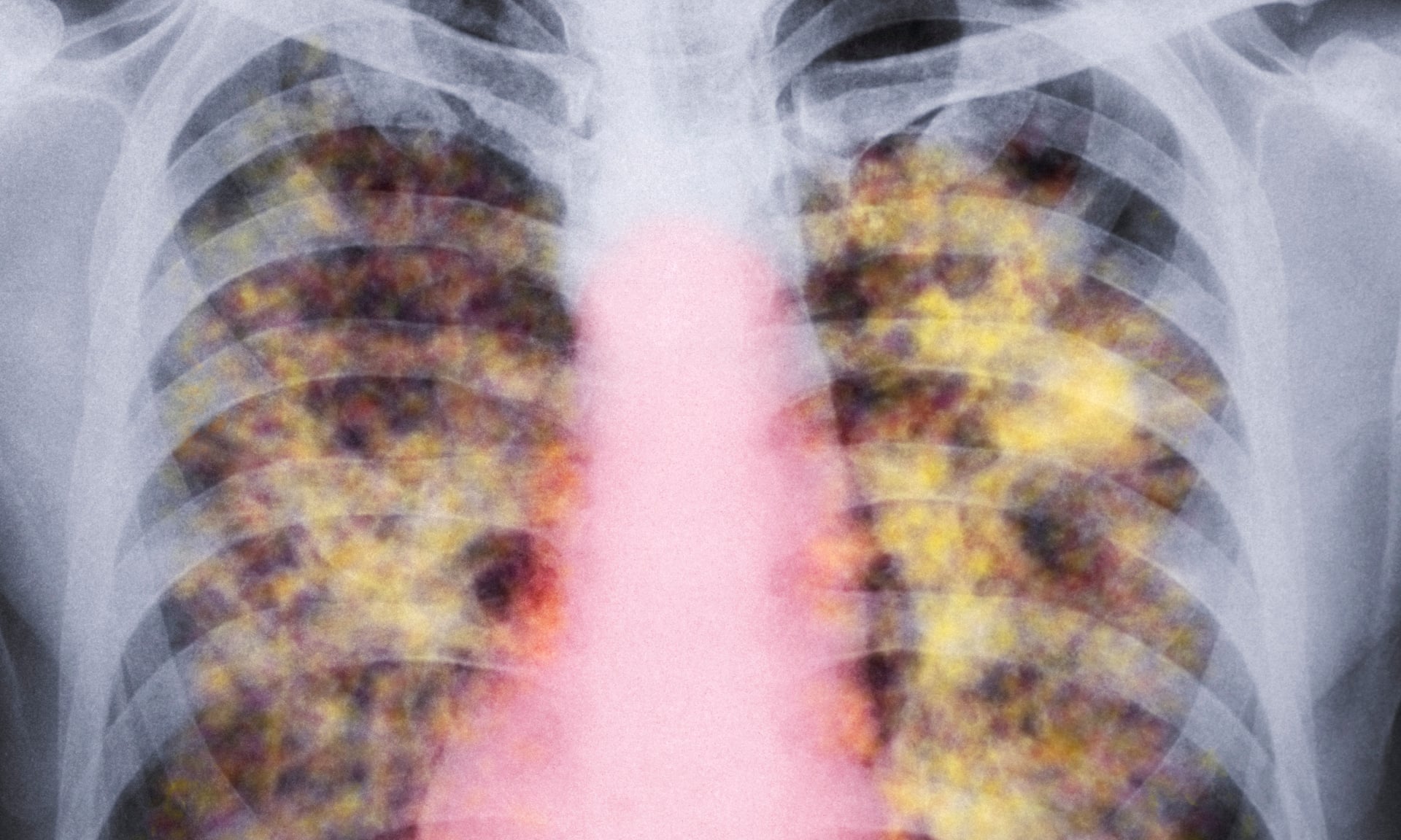 chest CT image showing asbestos damage