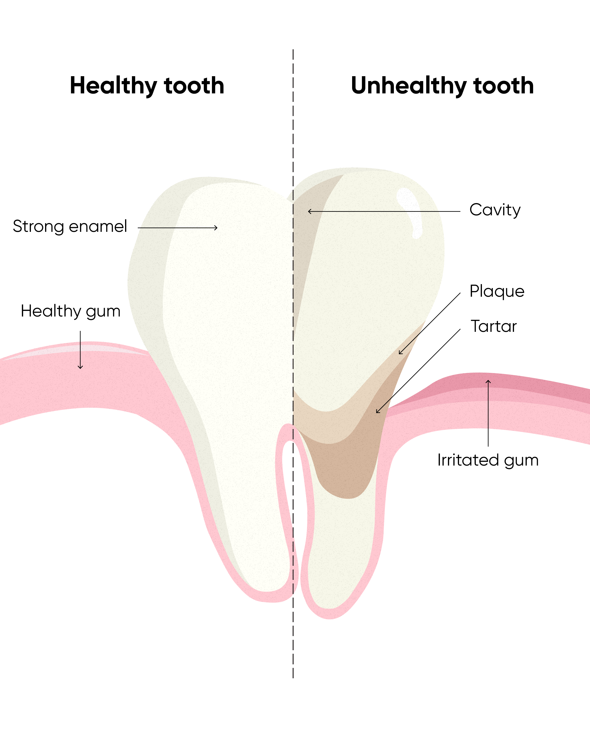 A diagram of a tooth showing the difference between a healthy tooth and an unhealthy tooth.