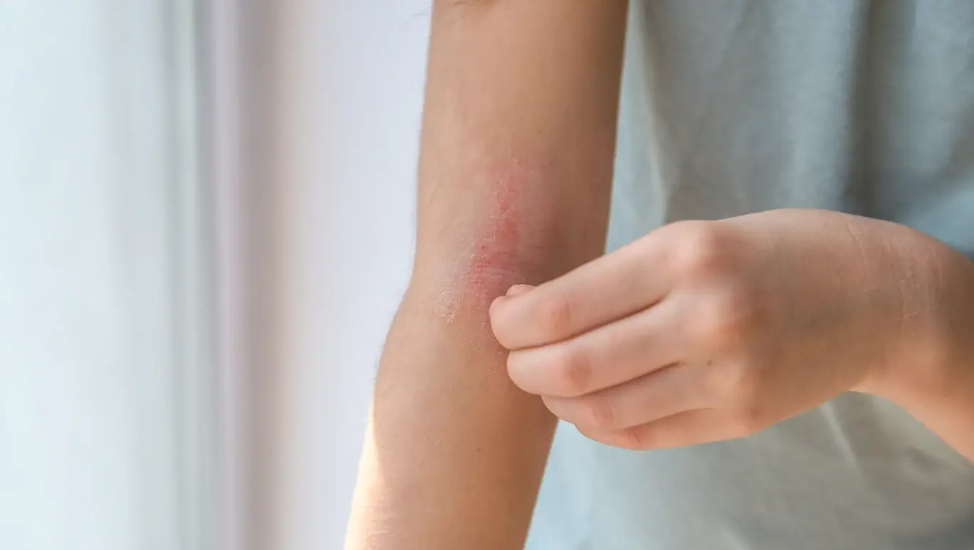 Eczema and food allergies: Leaky Gut Syndrome