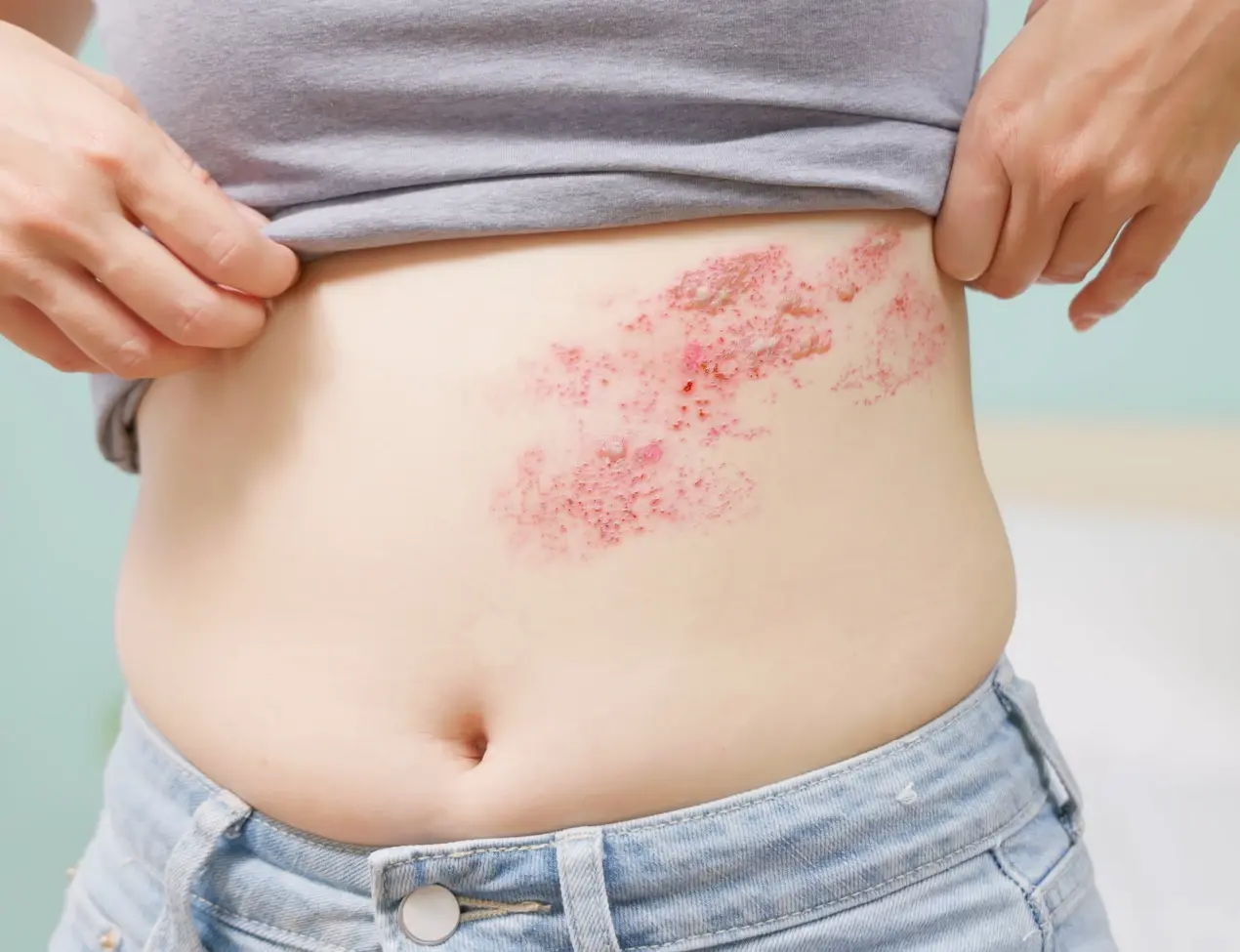 The different stages of shingles and what causes them