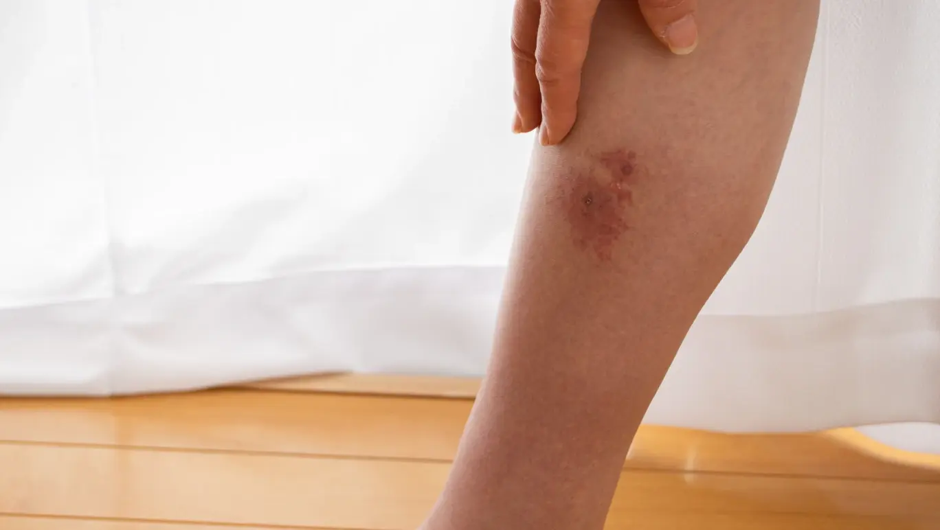 Natural remedies for cellulitis
