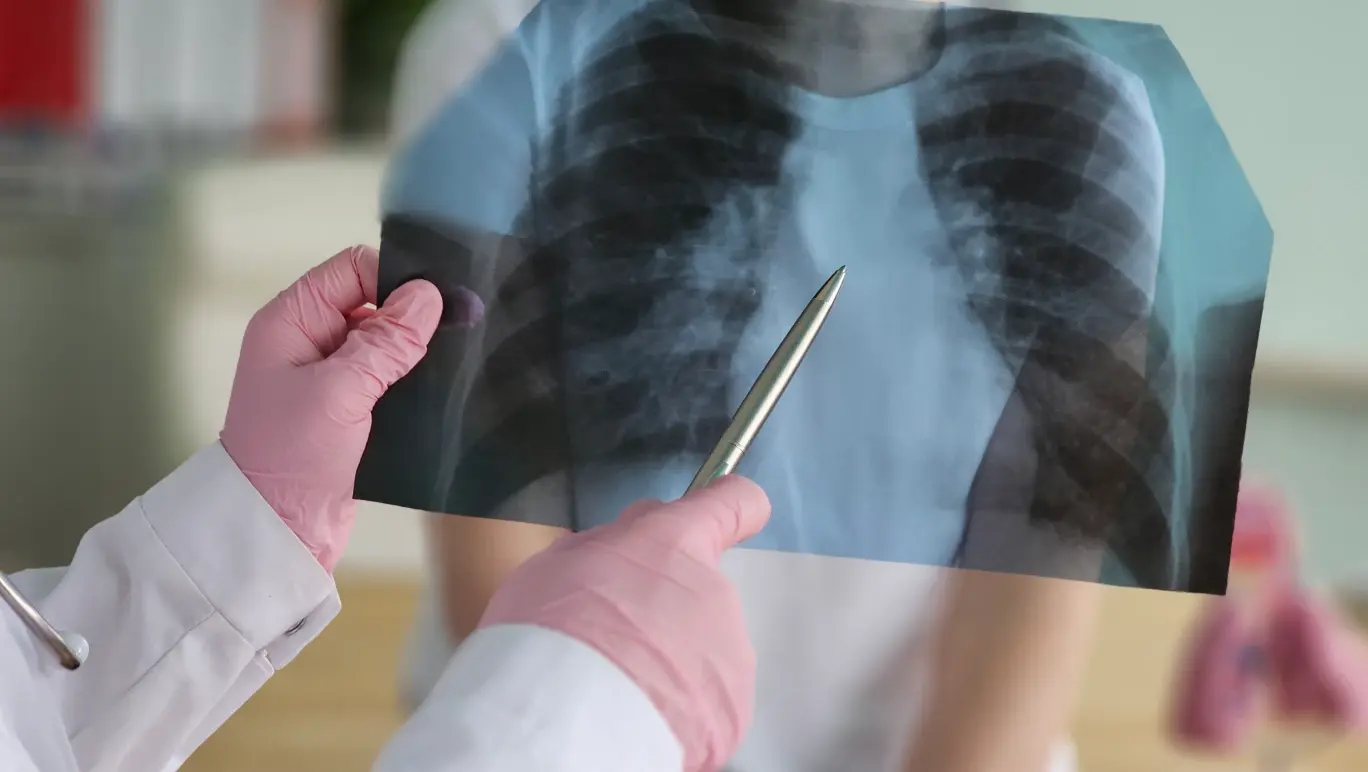 The stages of emphysema and life expectancy