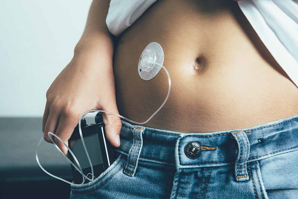 insulin pump on female belly
