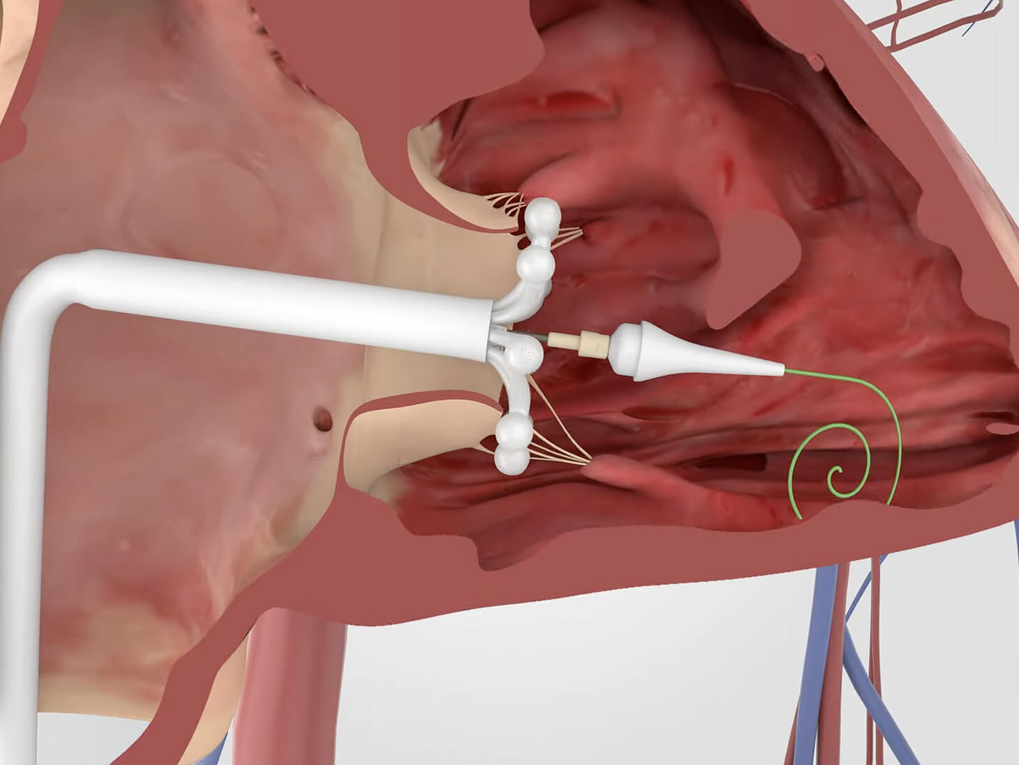 the implant is guided to the tricuspid valve