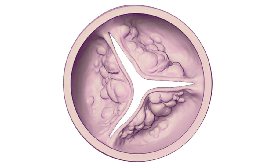 Does Aortic Stenosis get worse
