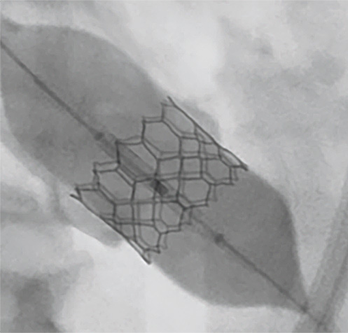 Transcatheter SAPIEN 3 Ultra stat image