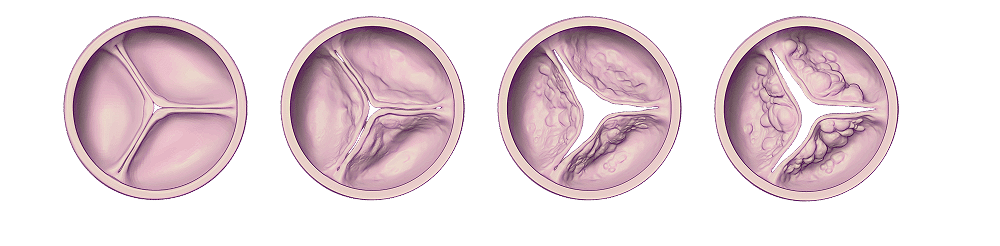 Why study moderate aortic stenosis