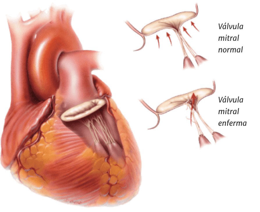 Degenerative valve disease