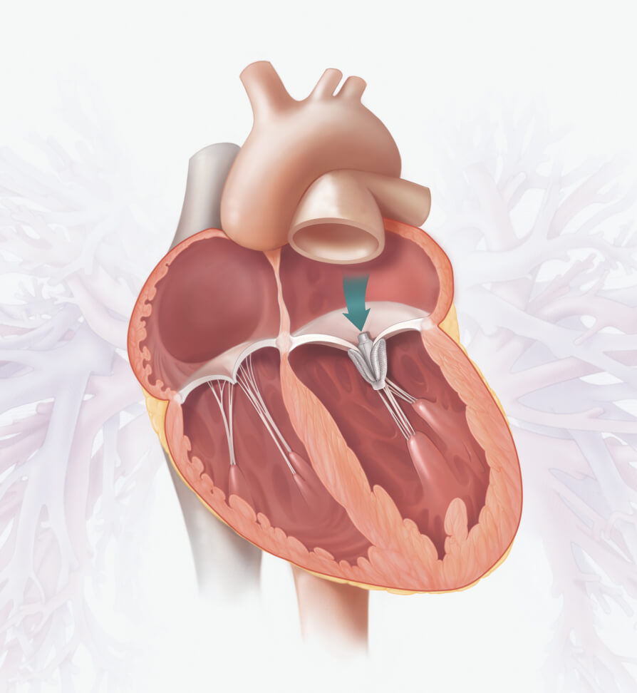 The PASCAL implant, pictured here in the mitral valve