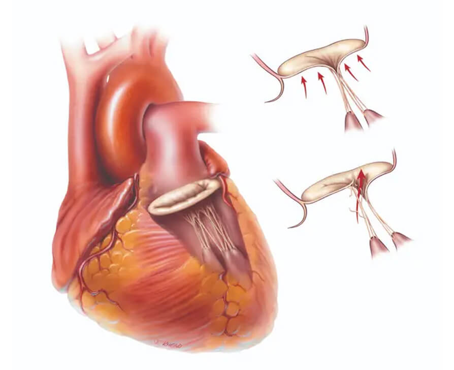 Types of valve disease Mitral regurgitation