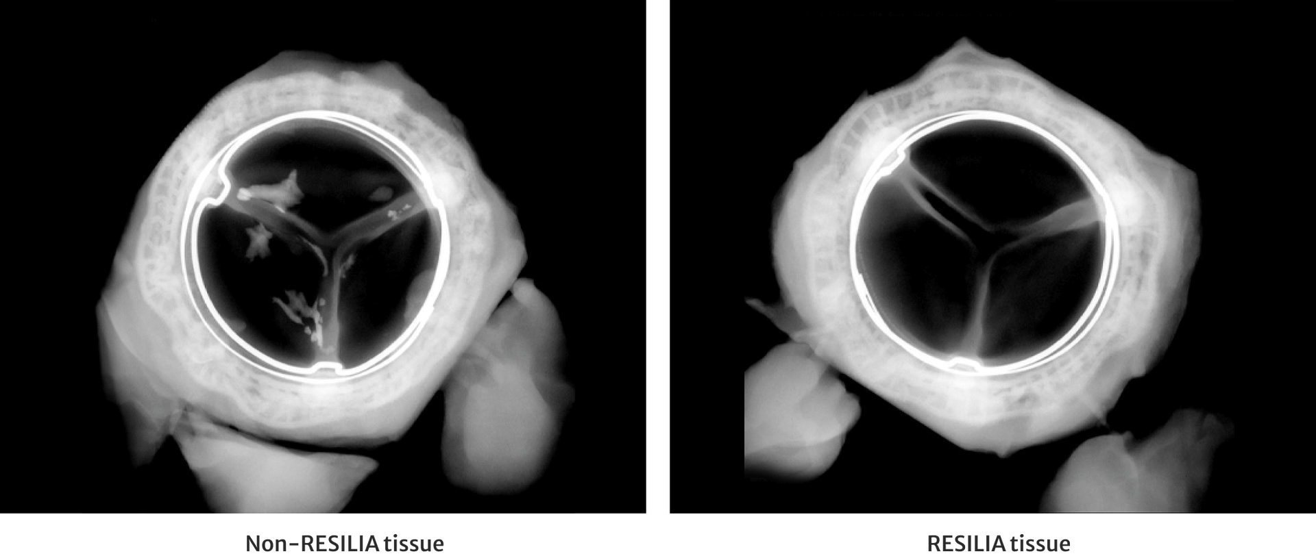 resilia valve comparison