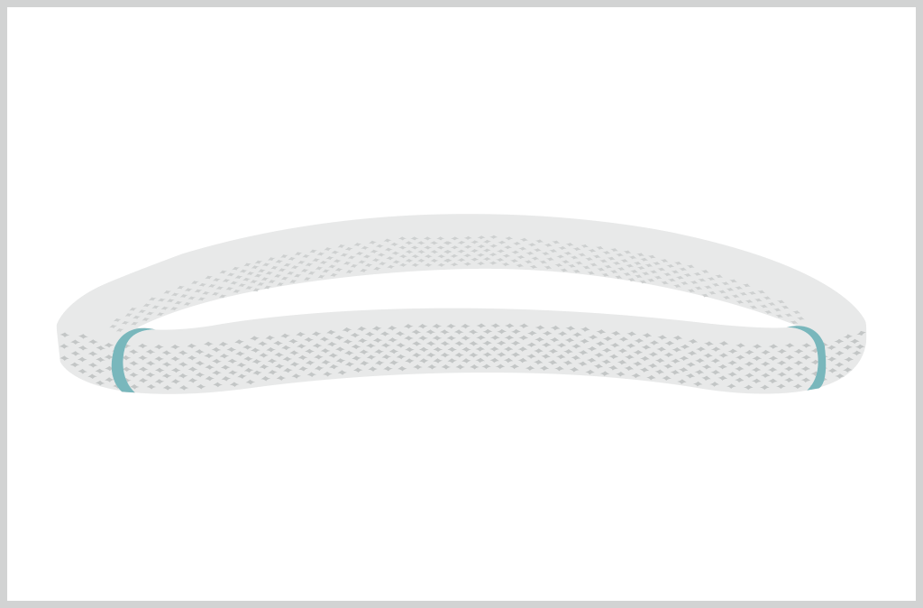 anterior saddle