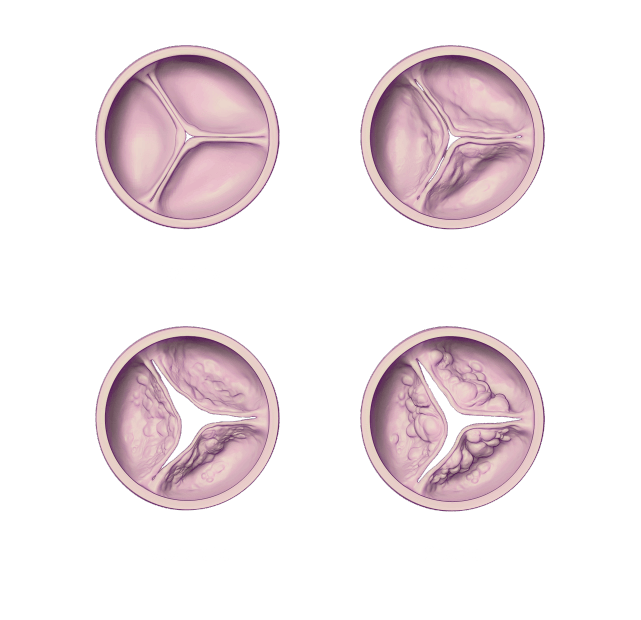 Why study moderate aortic stenosis