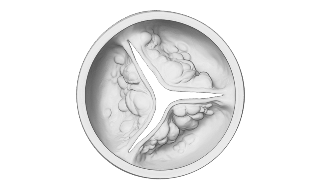 diseased aortic
