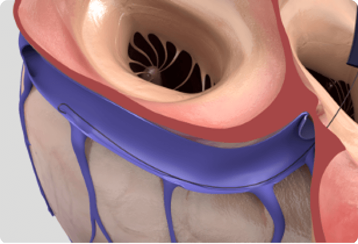 1 - Coronary sinus cannulation​