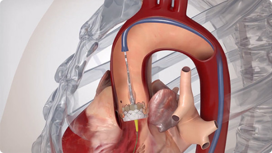 Catheter treatment "TAVI" procedure animation video 