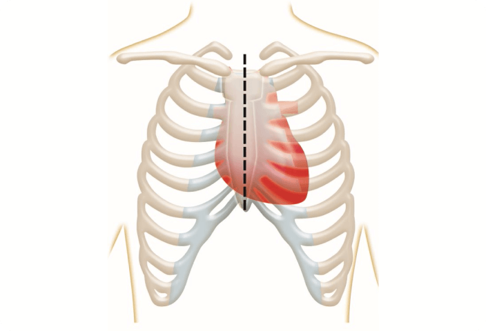Sternotomy