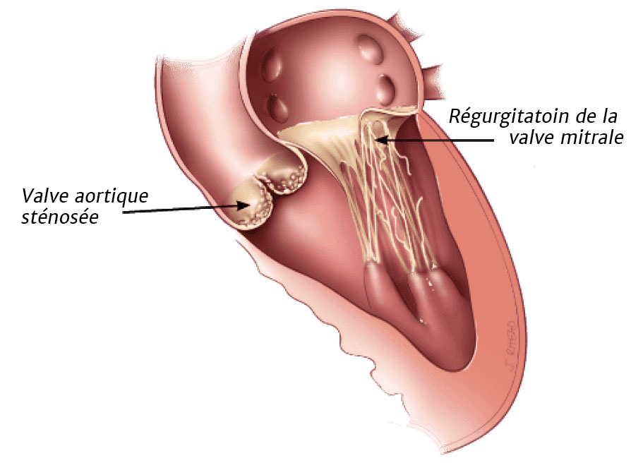 Valve aortique sténosée