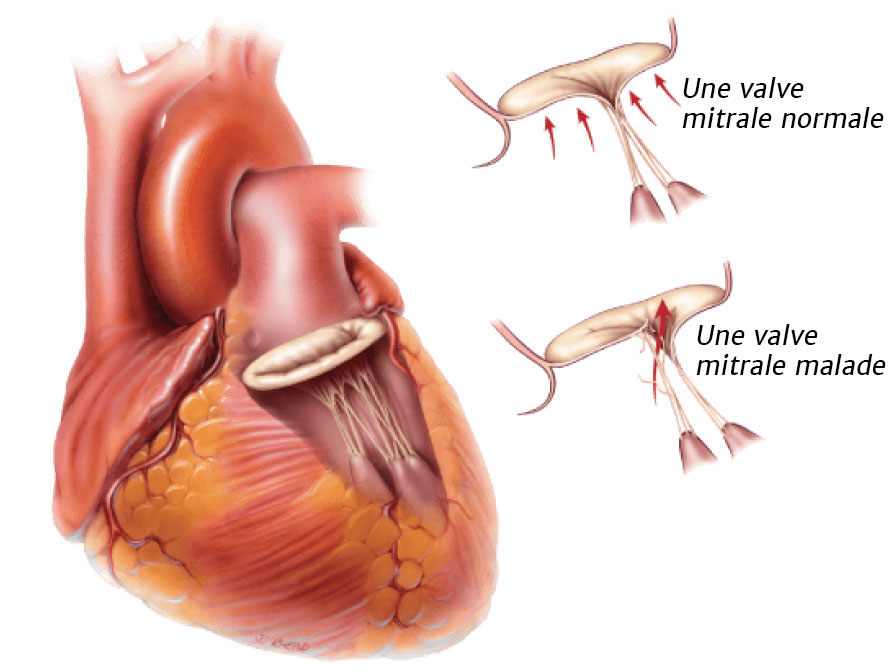 Degenerative valve disease