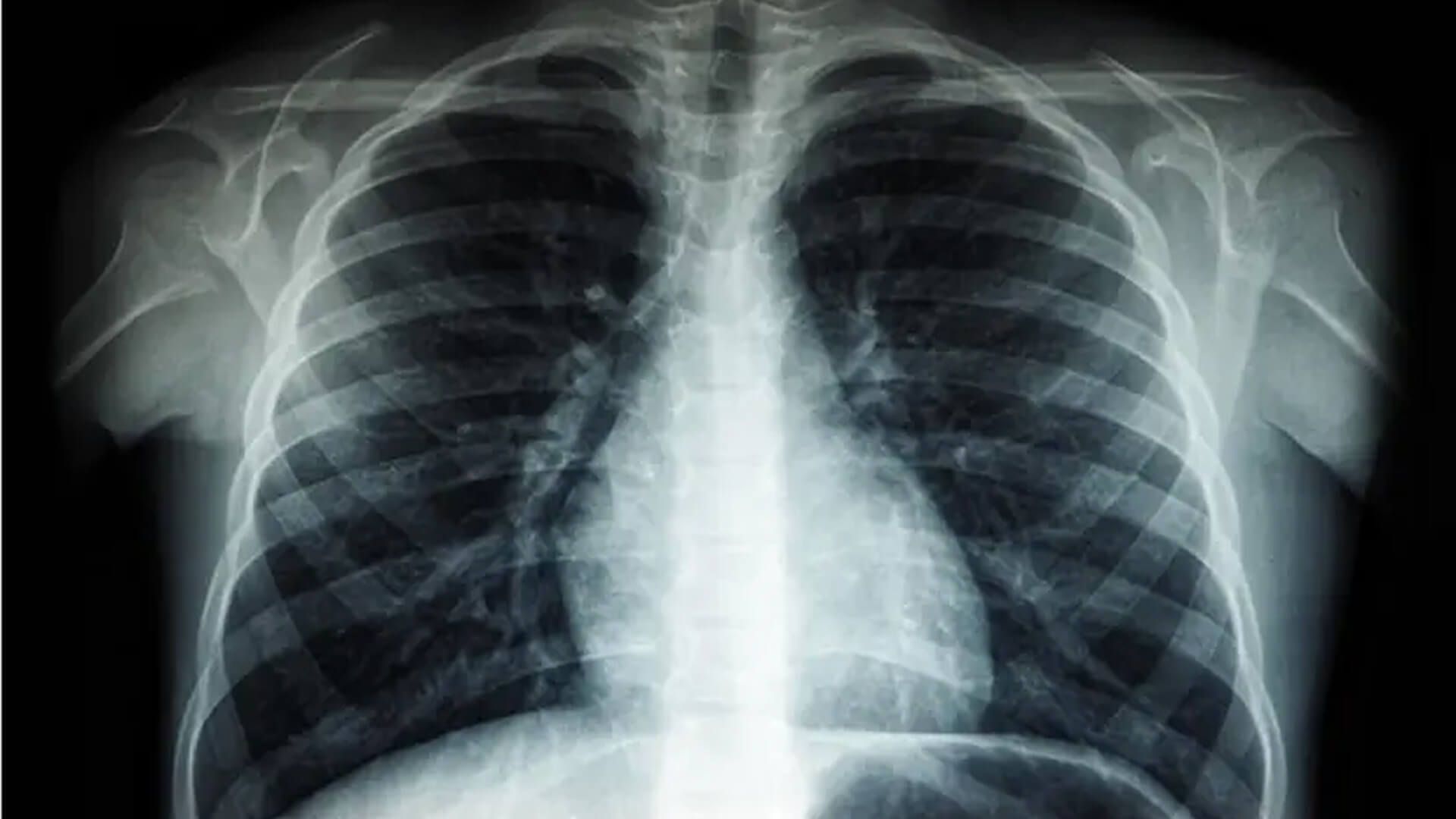 Chest X-ray