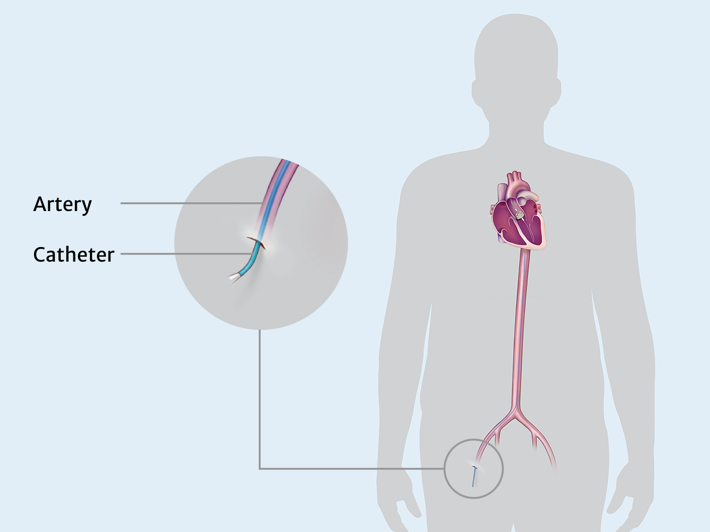 TAVR procedure: Step 1