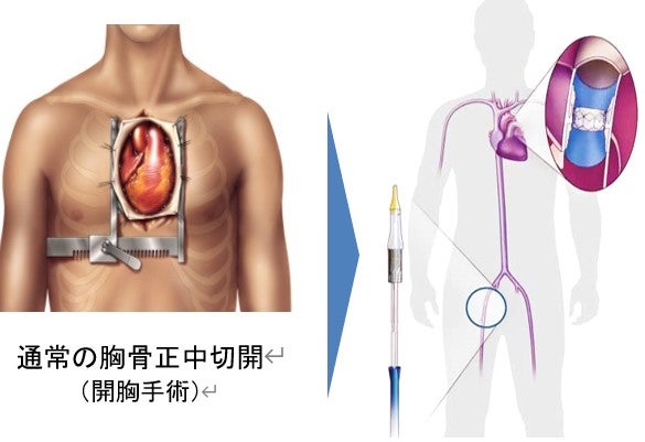 Japan's First Transcatheter Pulmonary Valve Treatment