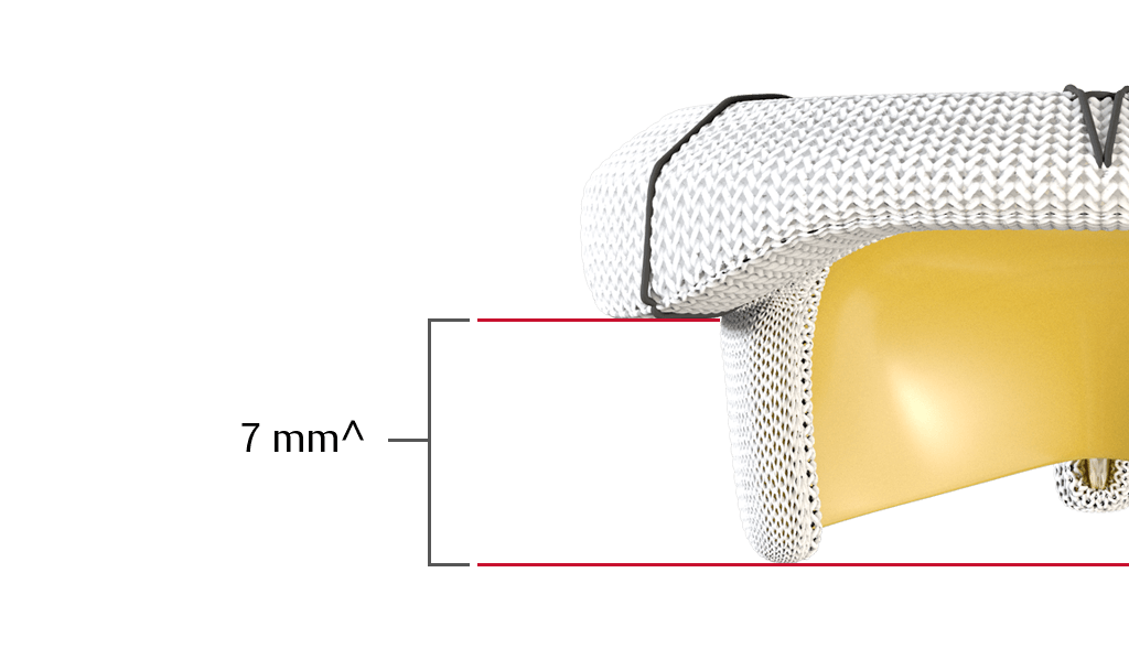 low profile stents