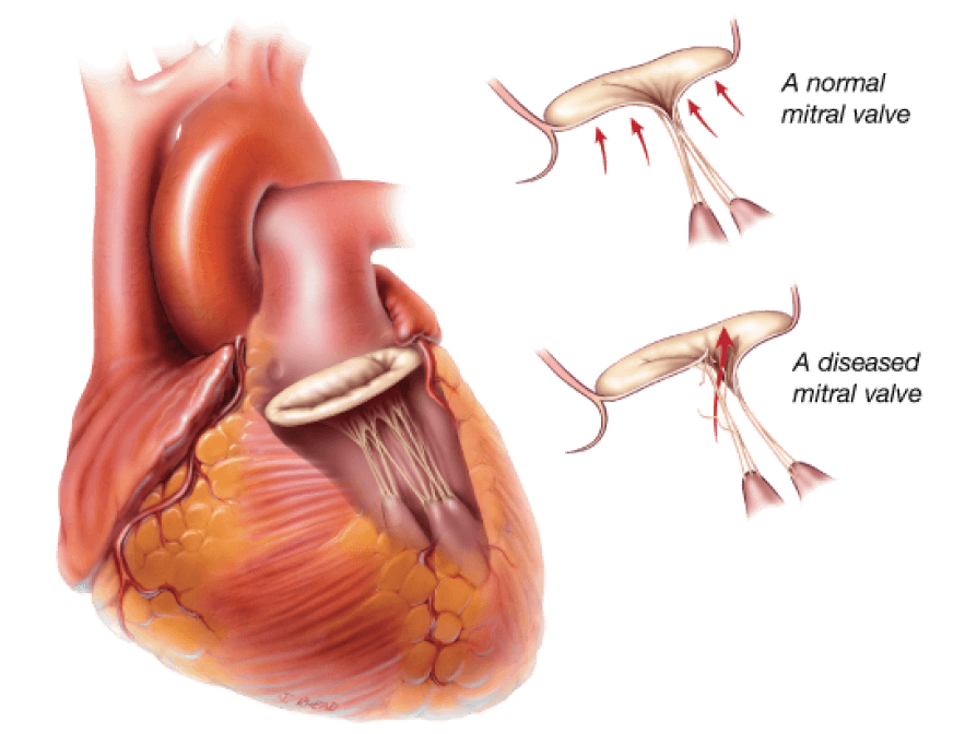 Degenerative valve disease