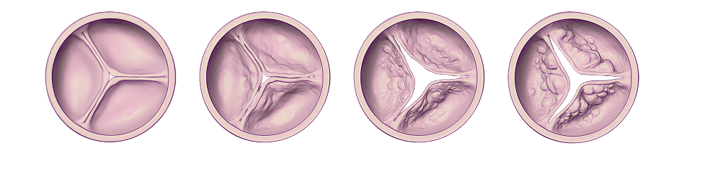 Disease Progression in Aortic Stenosis