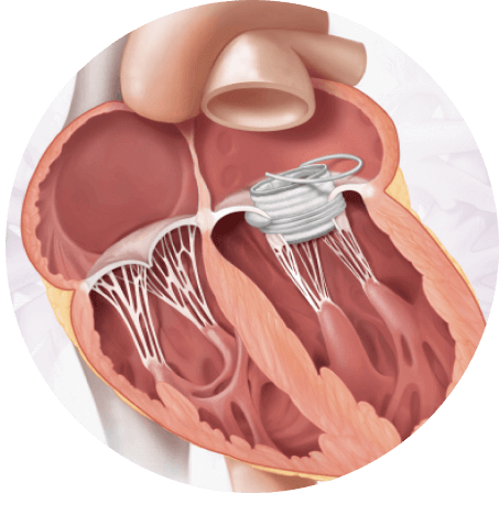 Final implant