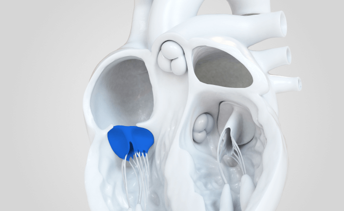 impact of tricuspid