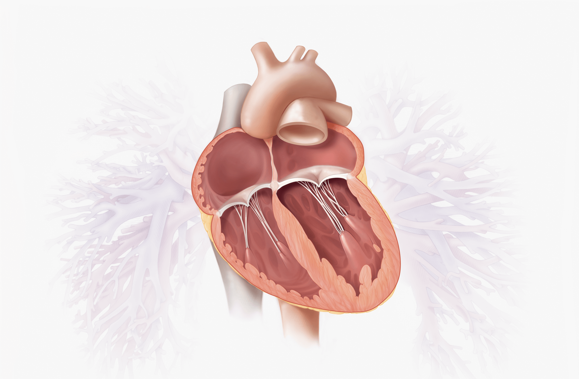 Degenerative MR (DMR) 2