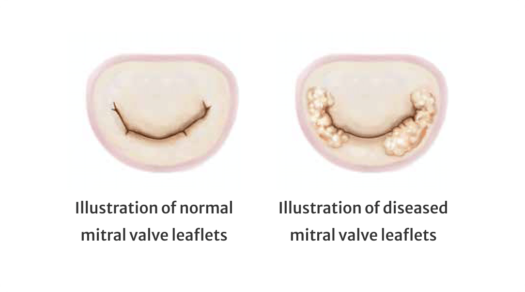 Mitral valve comparison