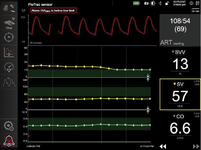 stroke volume variation