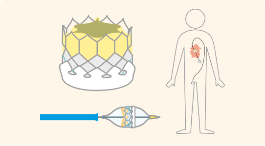Catheter treatment (TAVI)