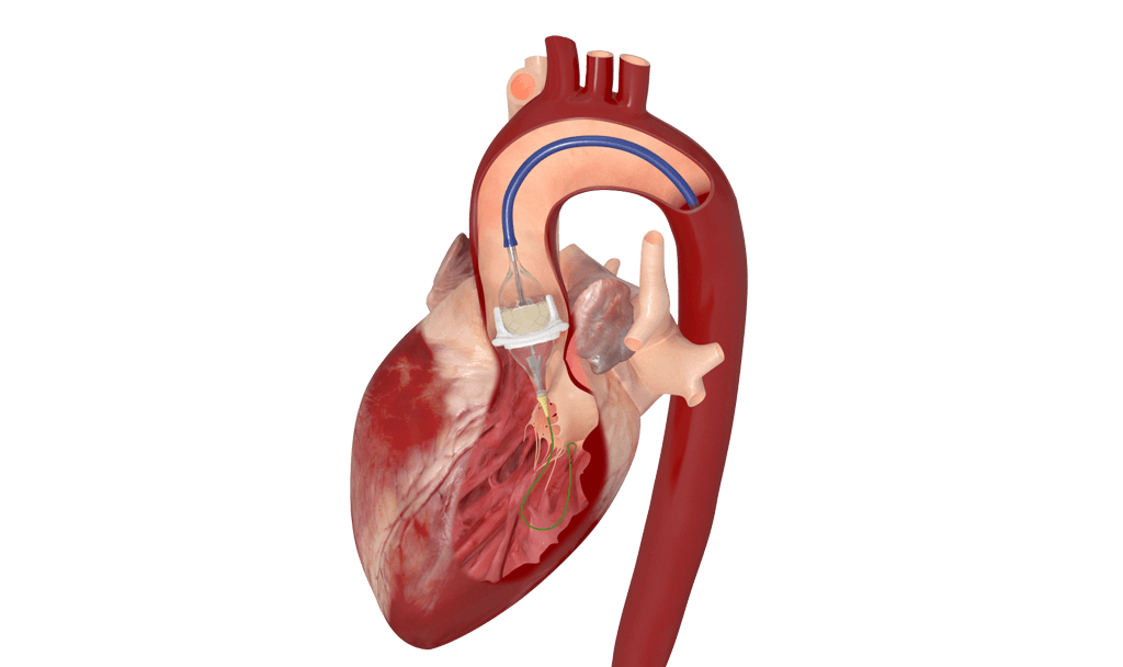 SAPIEN 3 valve in surgical aortic bioprosthetic valve - Anatomical illustration