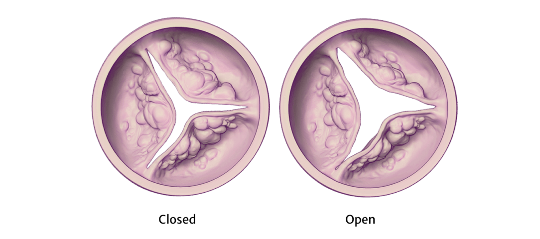 Deseased Aortic Valve