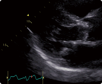 ultrasound