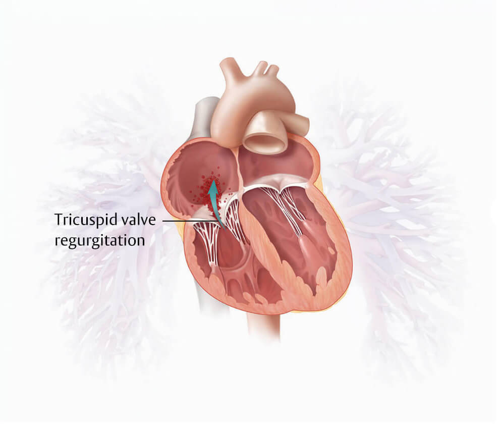 Tricuspid regurgitation