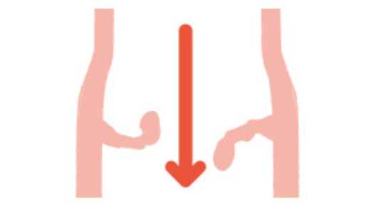 Insufficiency (regurgitation) when close