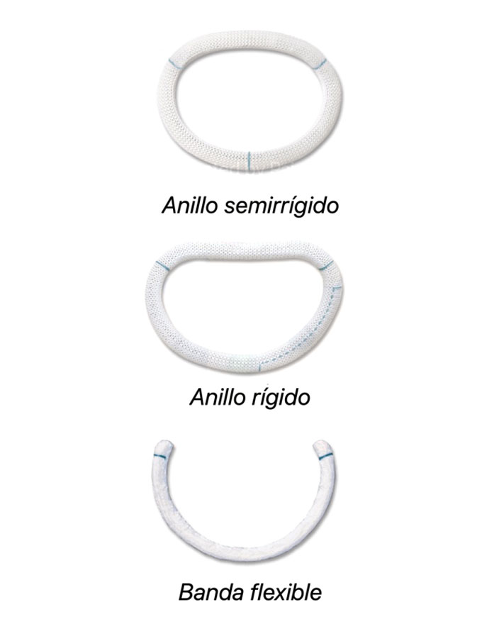 valve rings