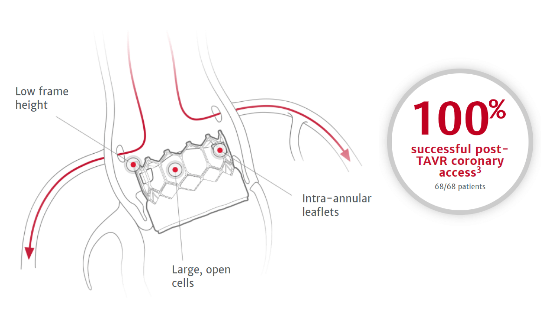 Transcatheter SAPIEN 3 Ultra info 3 image