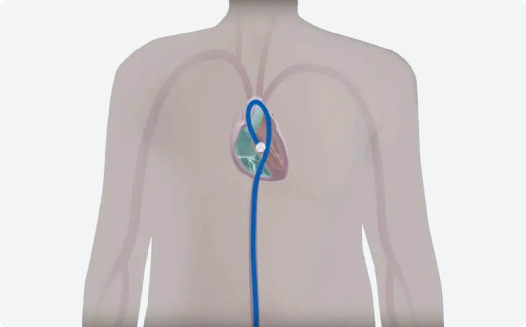 Step 4 TAVI Procedure